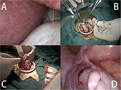 Single-Port Laparoscopic Surgery for Adnexal Mass Removal During Pregnancy: The Initial Experience of a Single Institute